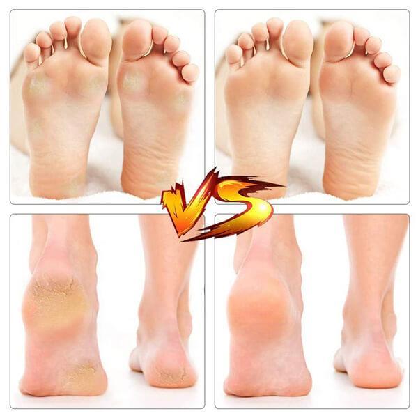 [🔥LAST PROMOTION&50% OFF] Electric Pedivac - Remove Your Callus Easily